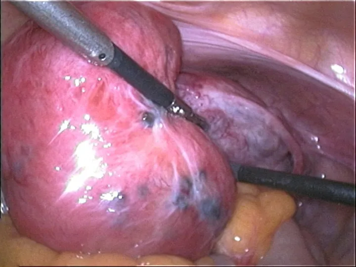 Laparoscopic view of an enlarged womb with dark spots of adenomyosis on its wall