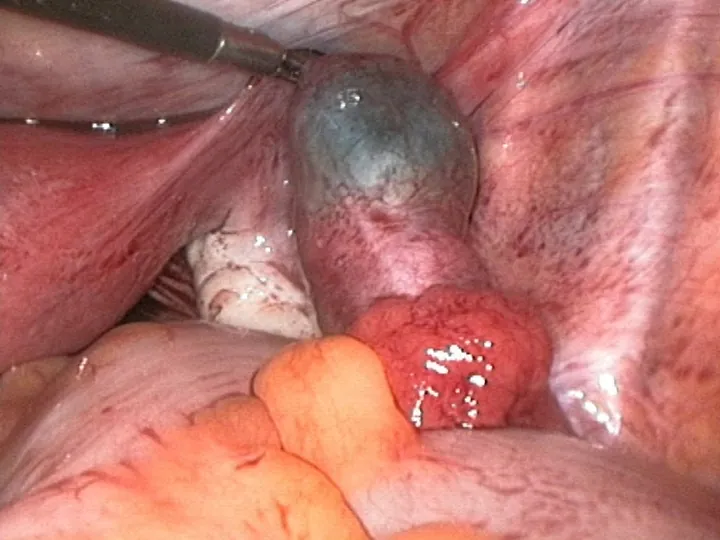Laparoscopic view of a fallopian tube swollen dark blue by an ectopic pregnancy