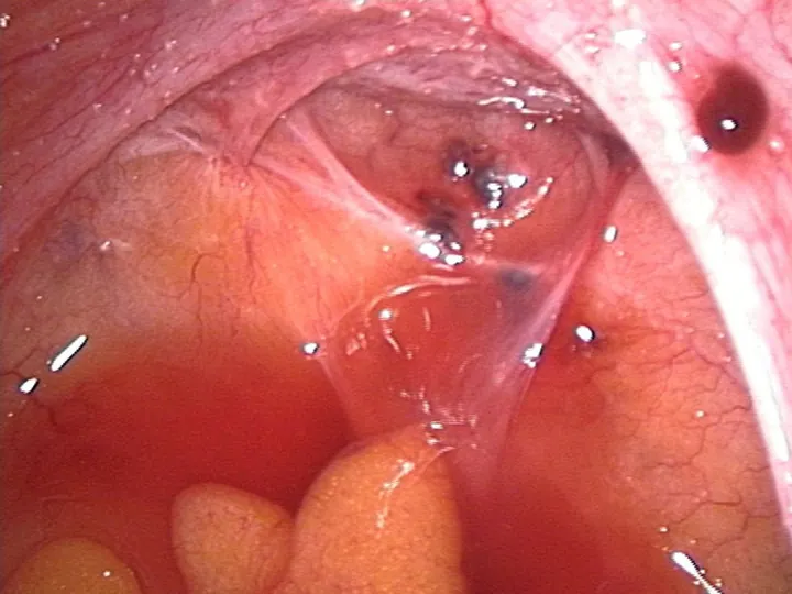 Laparoscopic view of dark endometriosis spots on the lining behind the womb