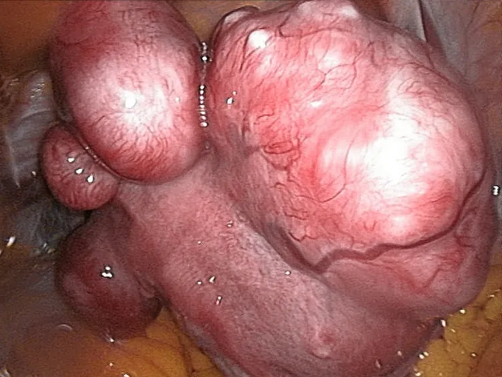 Laparoscopic view of a womb with several rounded fibroids on its surface