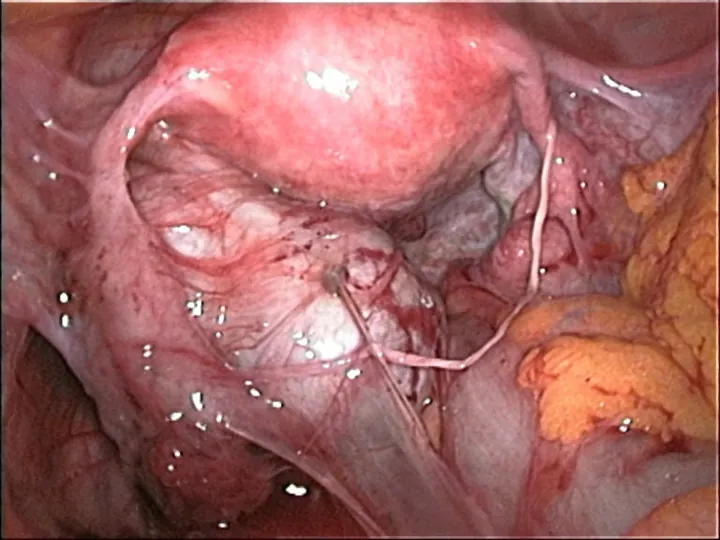 Laparoscopic view of a pelvis where bands of scar tissue join the womb to nearby organs