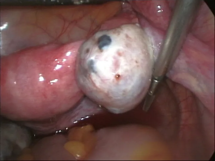 Laparoscopic view of a swollen ovary containing a cyst